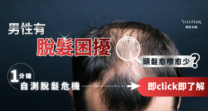 大部分男性脫髮始於30歲！1分鐘自測：髮線M化？頭頂見窿？髮根軟弱？即睇中咗邊一樣！